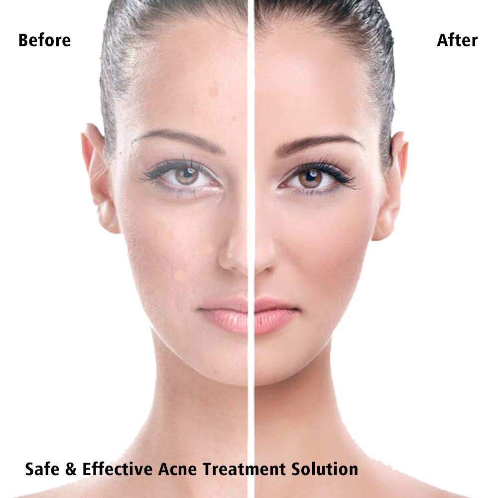 Pimple remover patch for face
