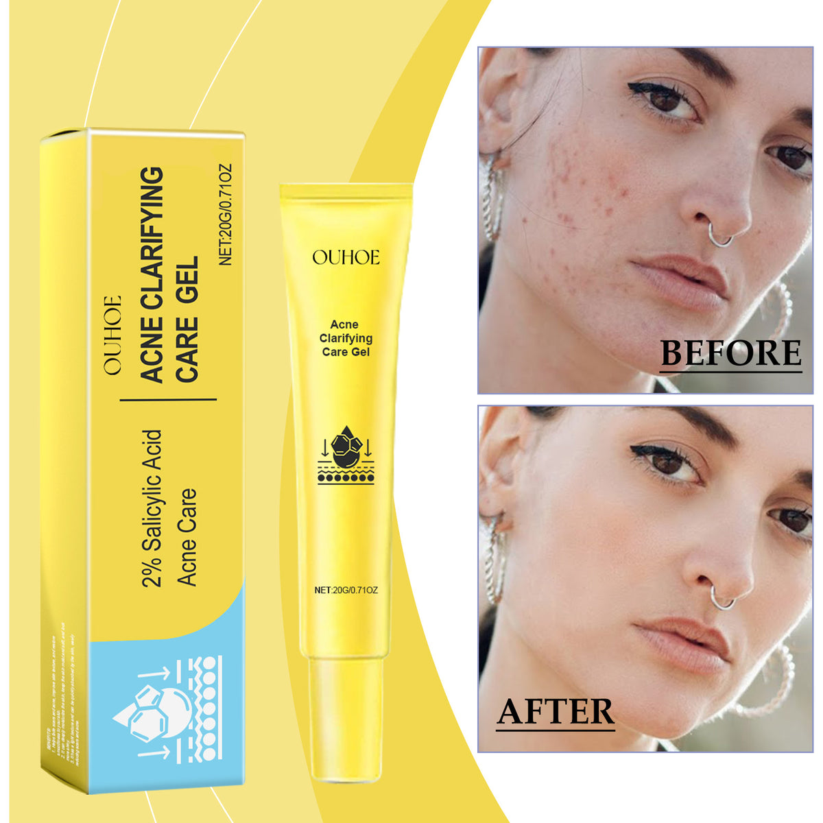 Deep cleansing acne gel