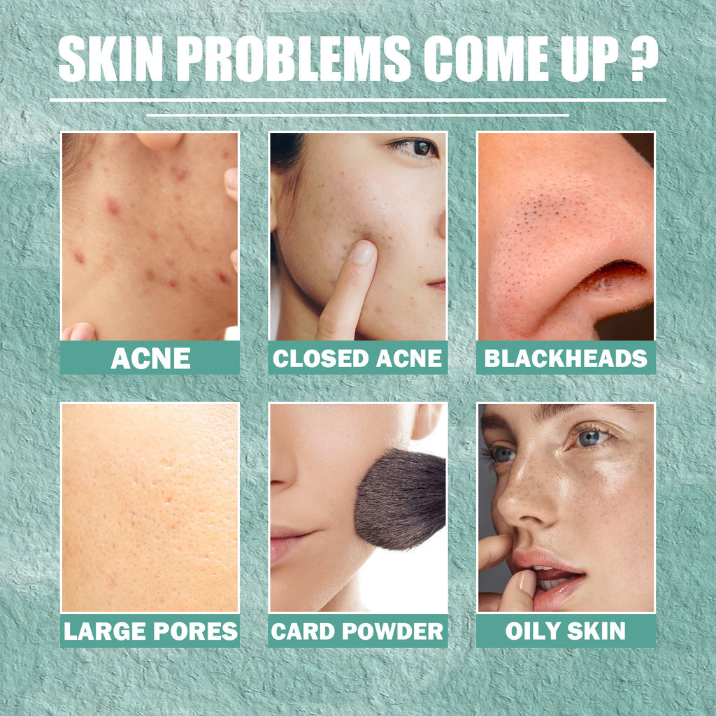 Cystic Acne Treatment face repair cream